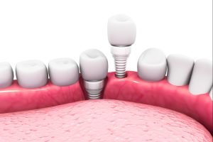 dental implants in lakefield