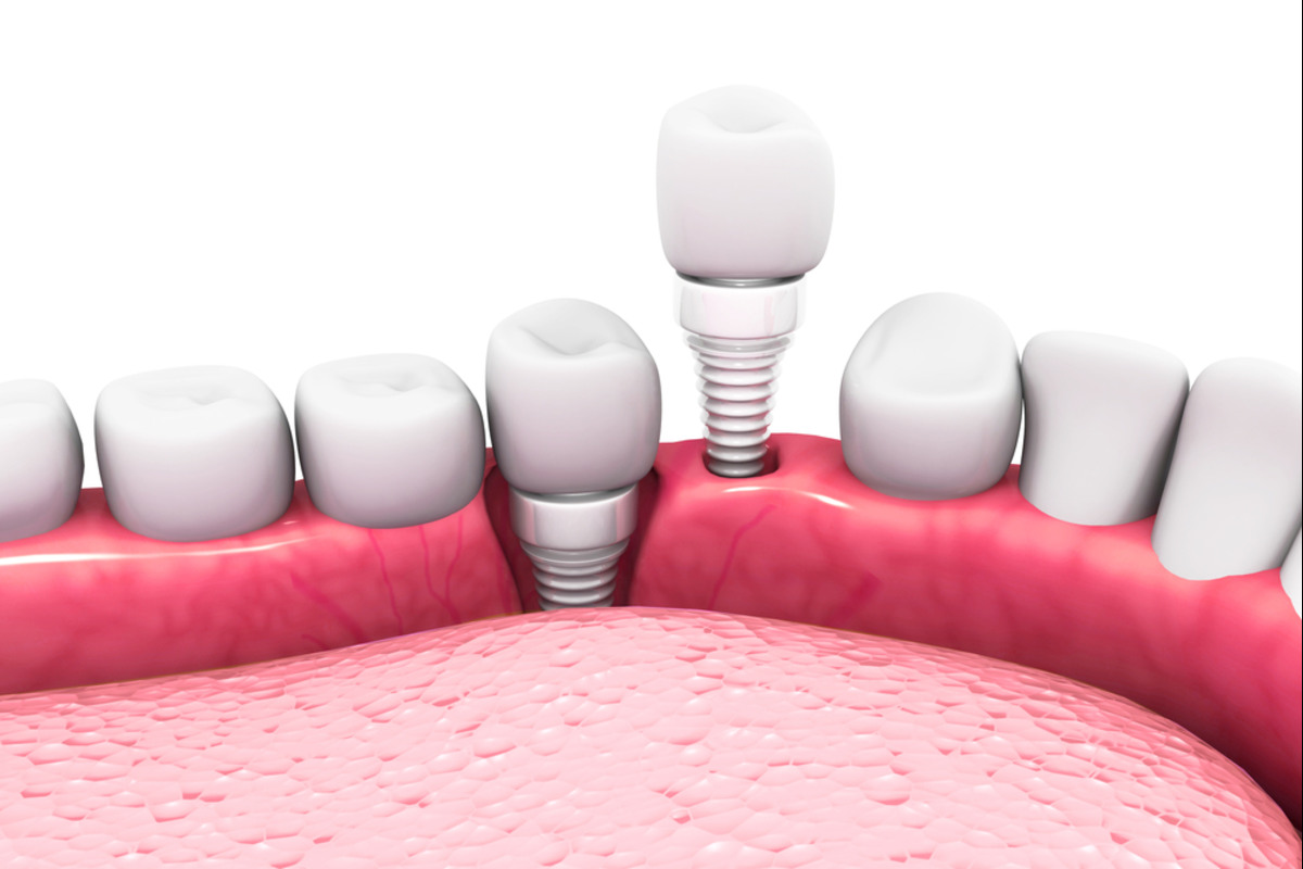 dental implants in lakefield