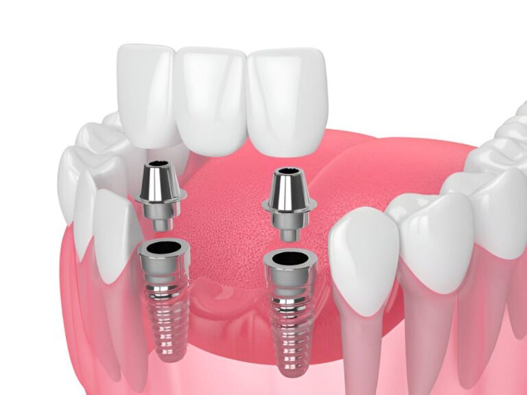 dental crown and bridges in lakefield village dental centre