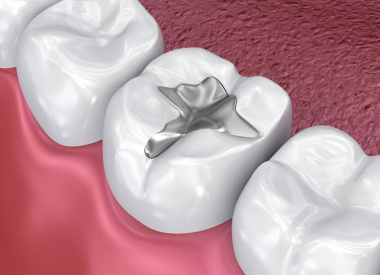 dental fillings in lakefield village dental centre