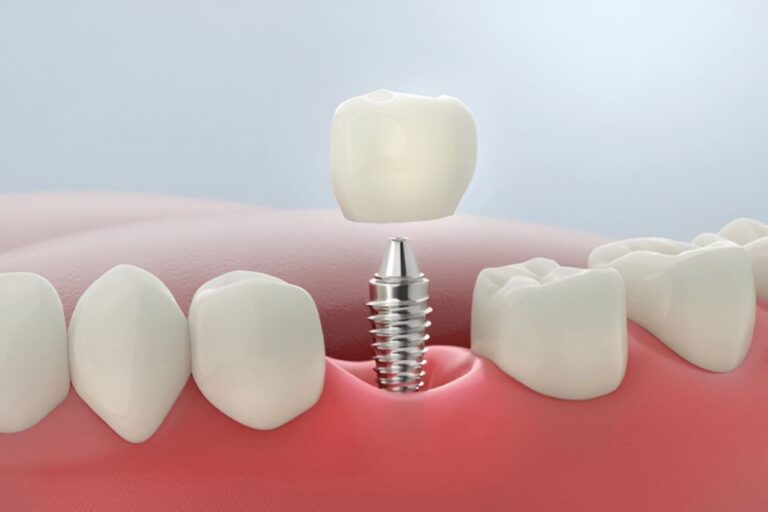 dental implants in lakefield village dental centre