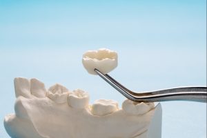 dental crown restoring damaged tooth