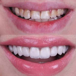 smile makeover whats actually involved