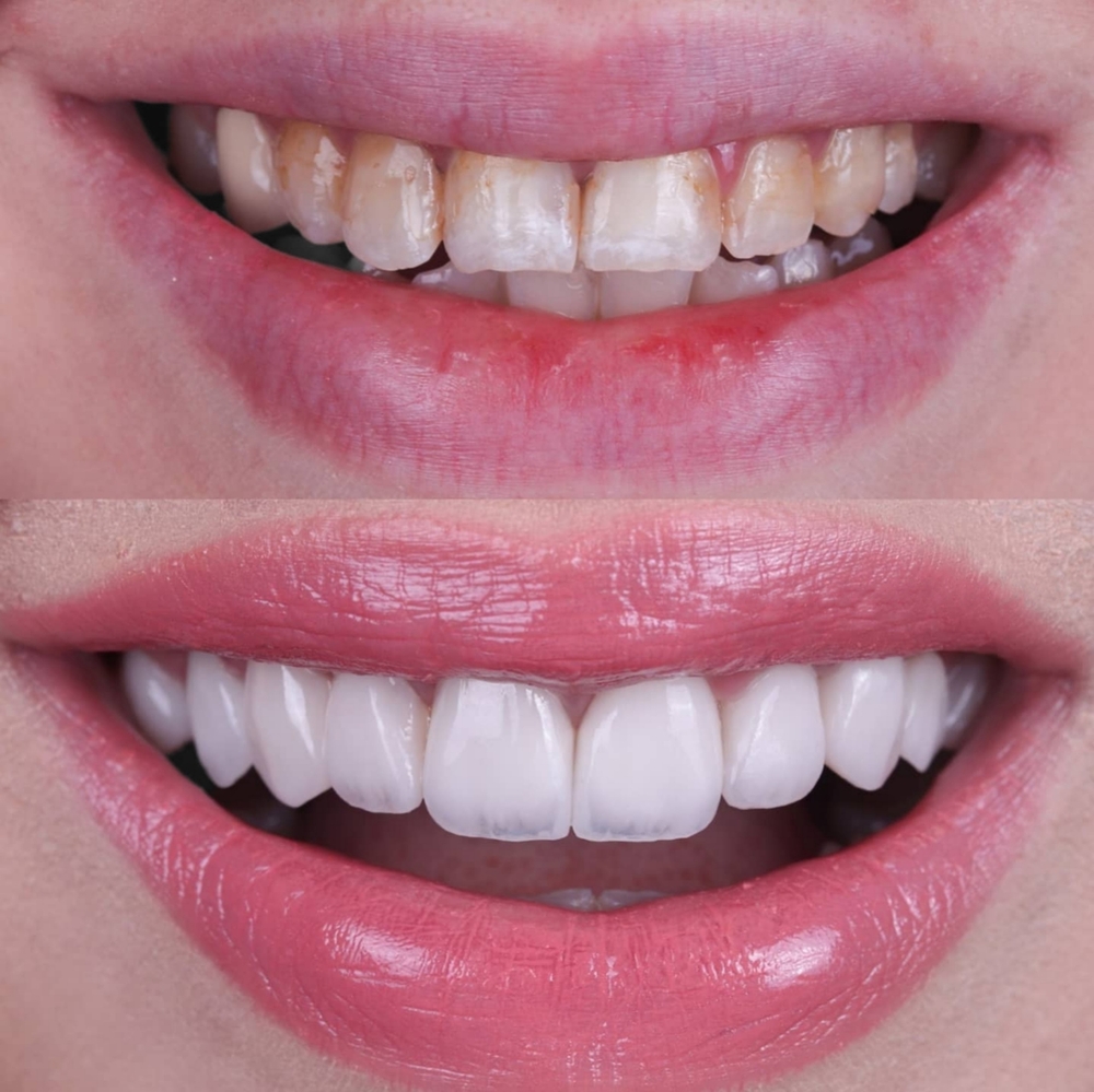 smile makeover whats actually involved